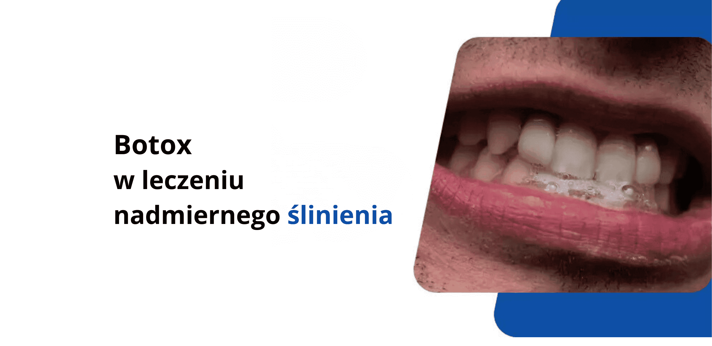 Toksyna botulinowa w leczeniu ślinotoku – wszystko o metodzie