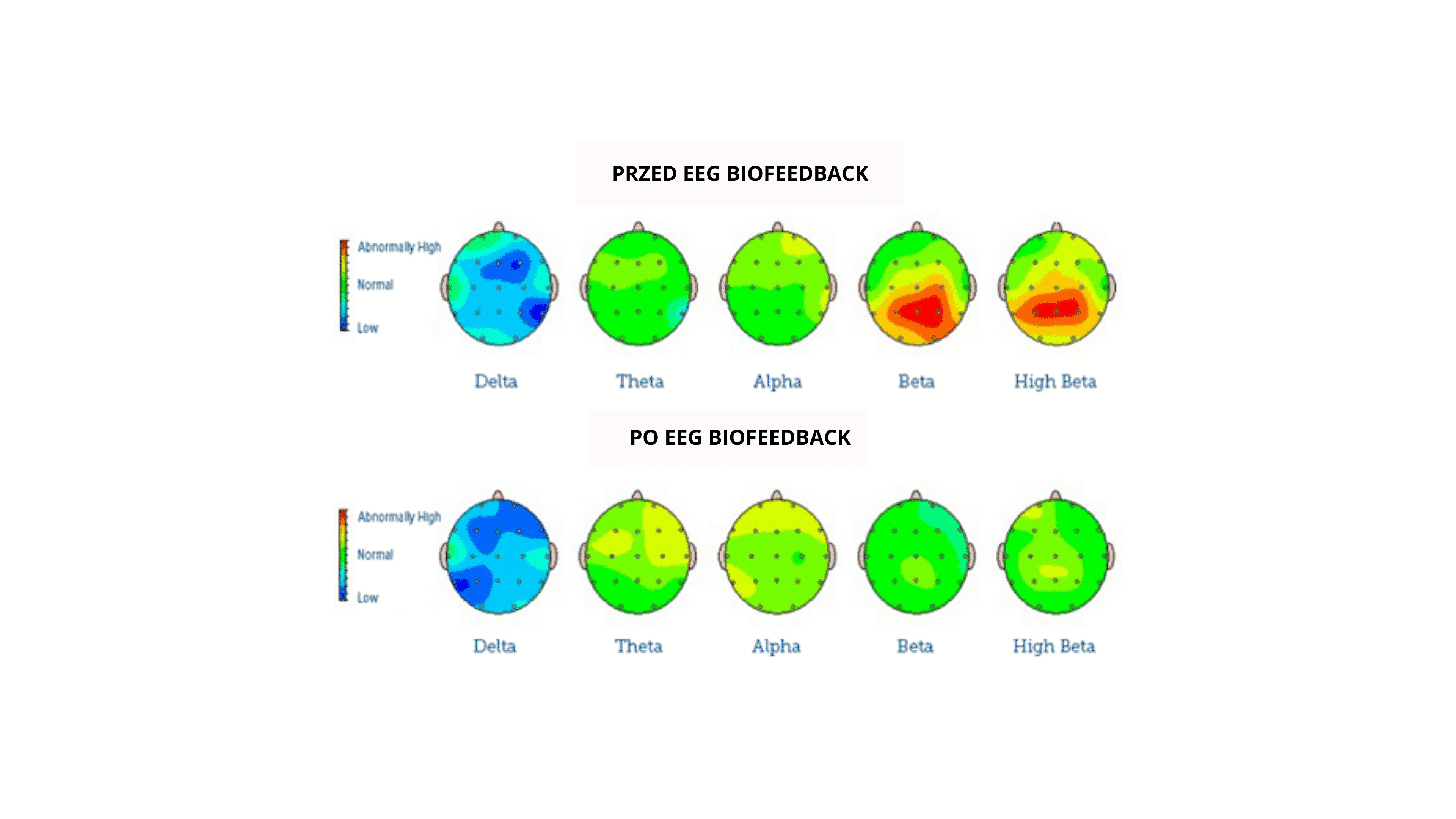 mapa mózgu przed i po terapii EEG